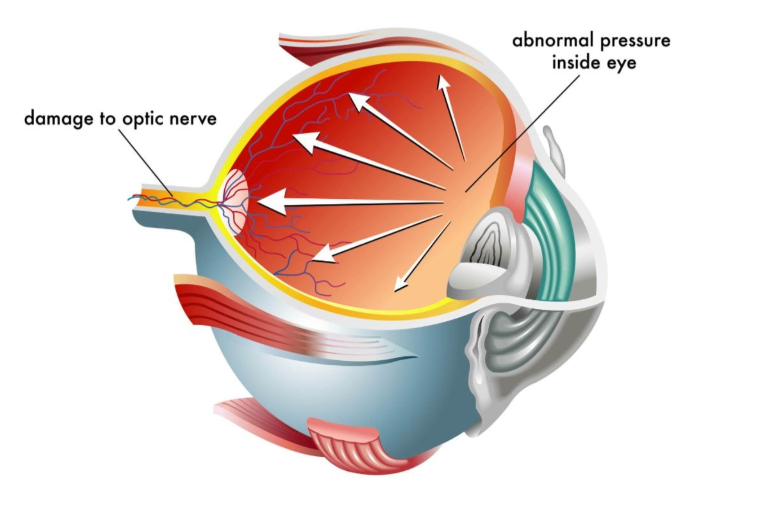 Glaucoma
