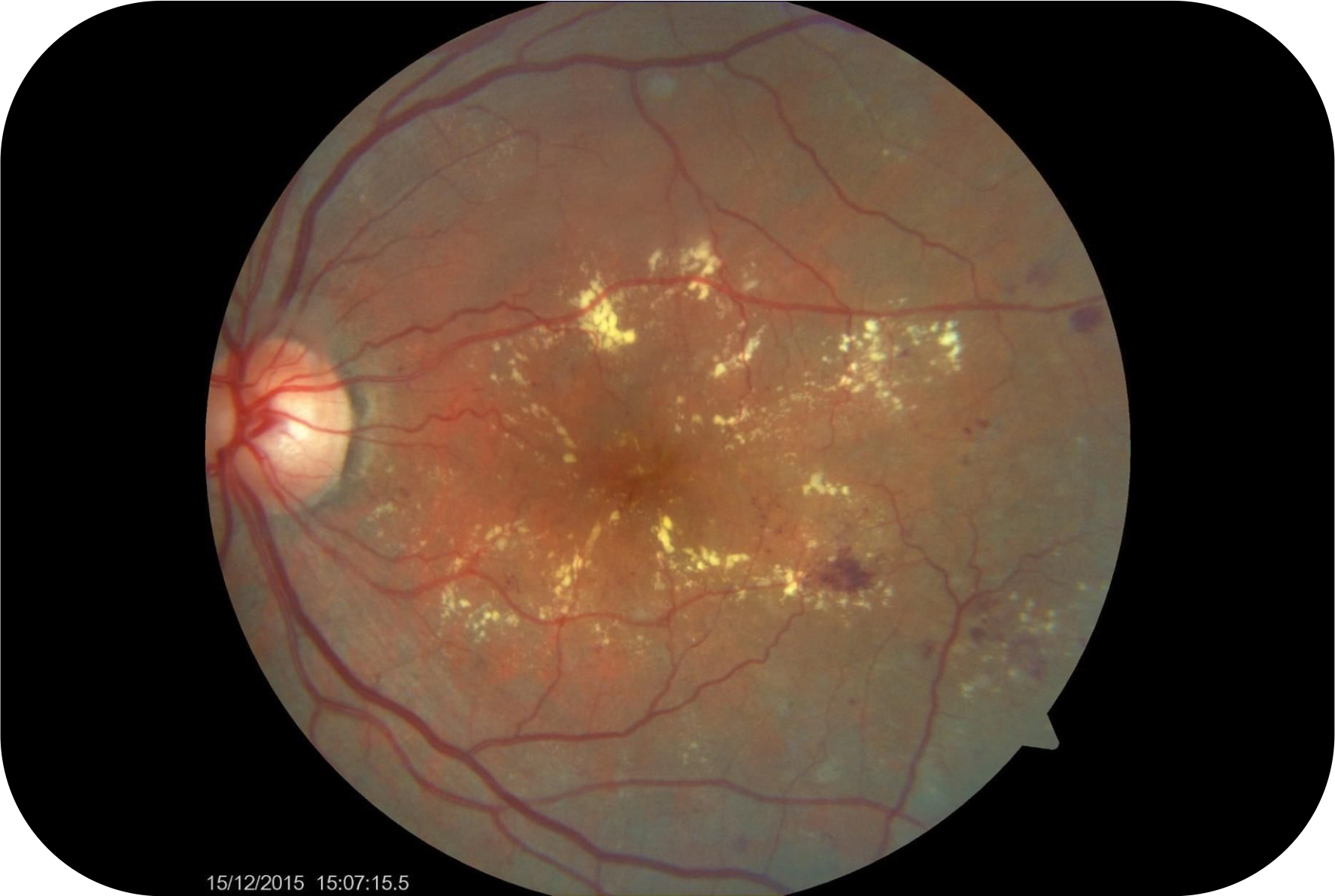 Retina